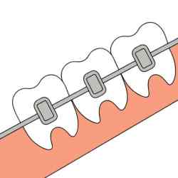 An image depicting a single tooth fitted with braces, illustrating the process of orthodontic correction.